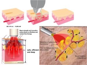 Diode Laser Treatment For Spider Or Varicose Vein