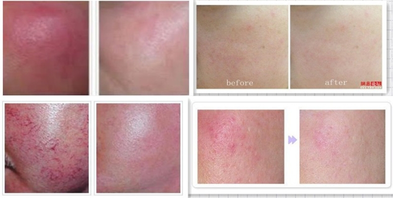 Diode Laser Vascular Removal Before and After