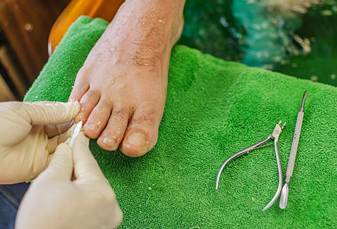 Traditional Nail Fungus Treatment