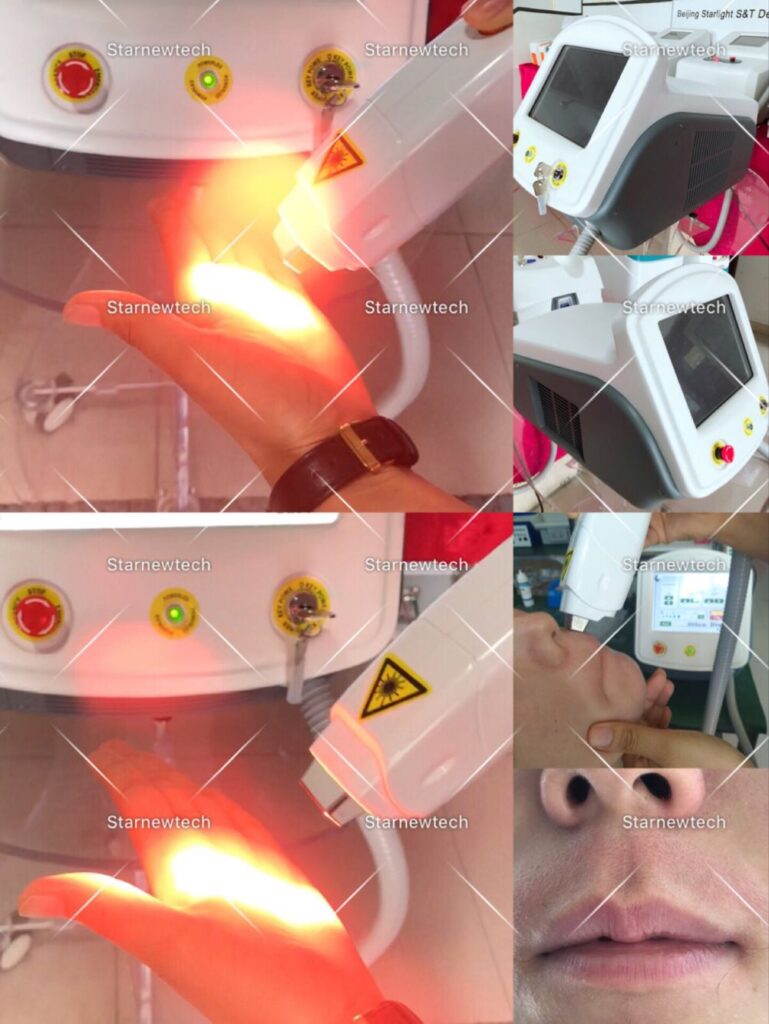 Diode Laser Hair Removal Machine Face Treatment