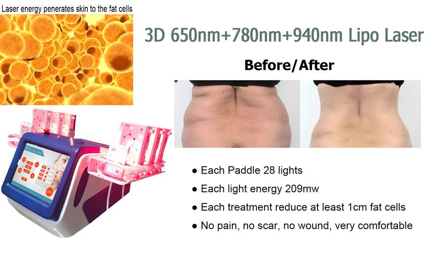 3D Lipo Laser Machine Treatment Before and After
