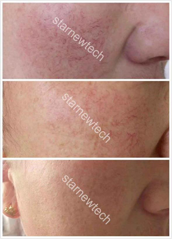 Result Of Diode Laser Vascular Removal