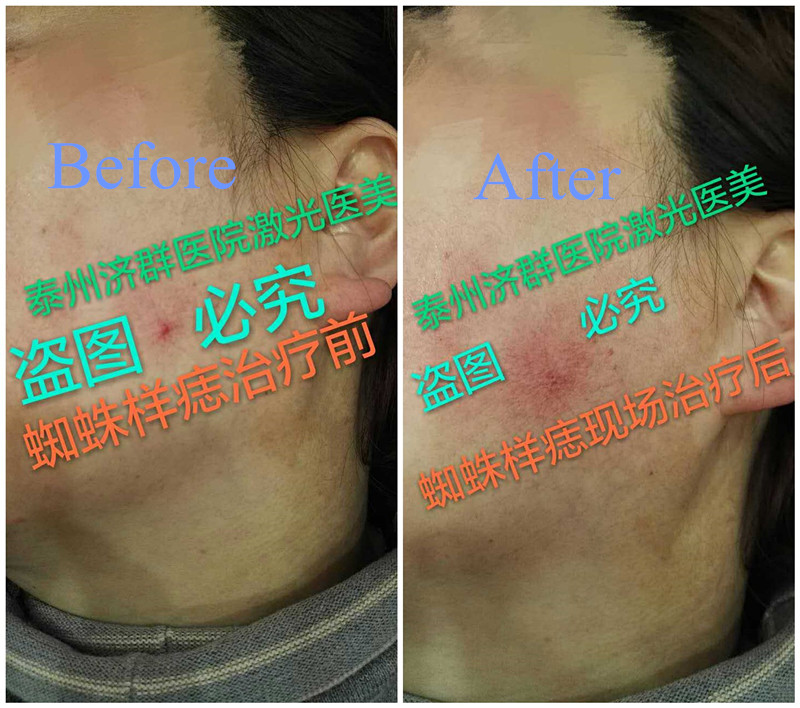 Spider Vein Treatment Before and After Result