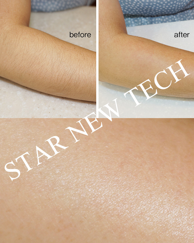 Diode Laser Hair Removal Machine Treatment Proof Result