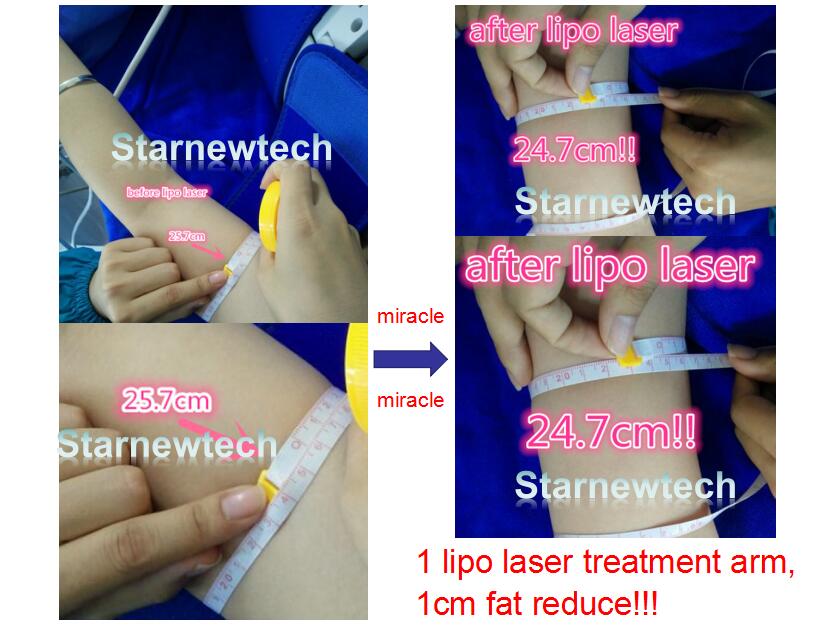 Lipo Laser Treatment Arm Fa Reduce Result