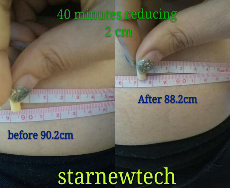 5D Lipo Laser Machine Treatment Result