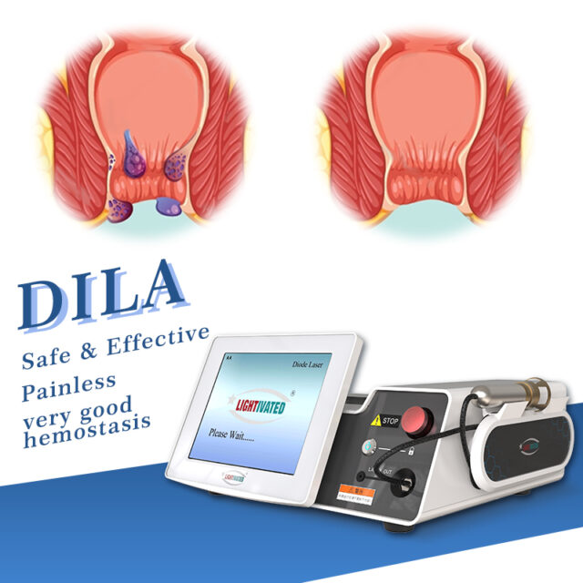 Hemorrhoids Laser